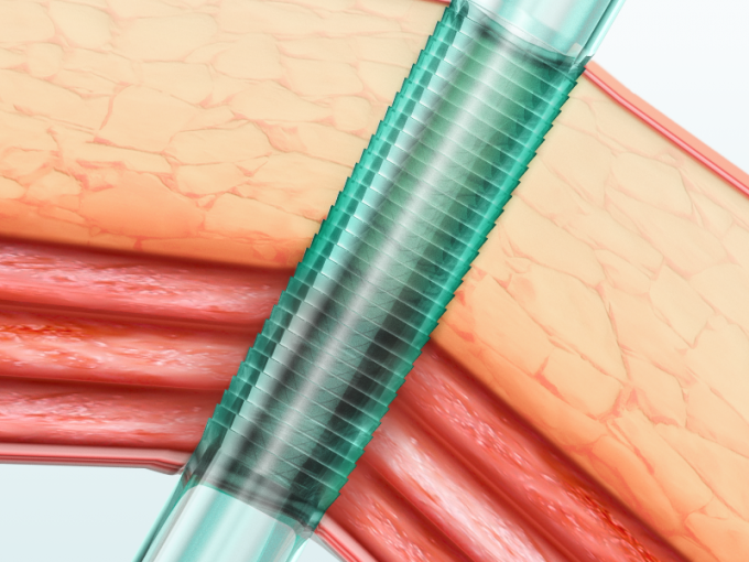 آخرین اخبار شرکت ویژگی ها و مزایای تروکار لاپاراسکوپی یکبار مصرف اندوپاس | SurgSci  0