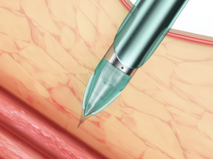 آخرین اخبار شرکت ویژگی ها و مزایای تروکار لاپاراسکوپی یکبار مصرف اندوپاس | SurgSci  1