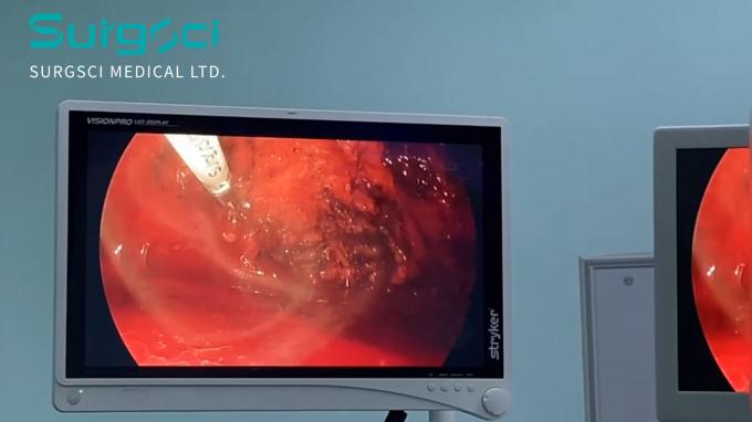 آخرین اخبار شرکت فتق: علل، انواع و گزینه های درمانی | Surgsci  0