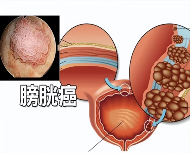 آخرین اخبار شرکت تشخیص بالینی و مراقبت فیزیولوژیکی از سرطان مثانه.  0